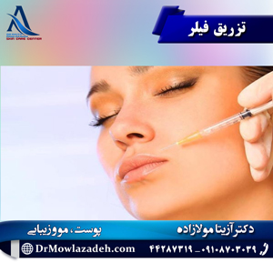 تزریق فیلر
