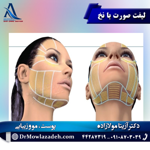 لیفت-صورت-با-نخ
