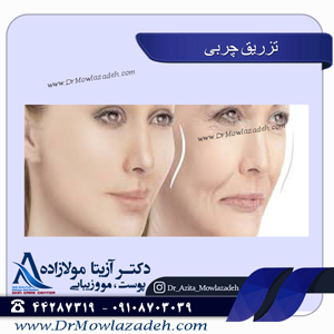 تزریق-چربی