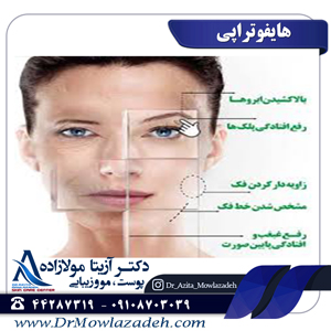 عوارض هایفوتراپی
