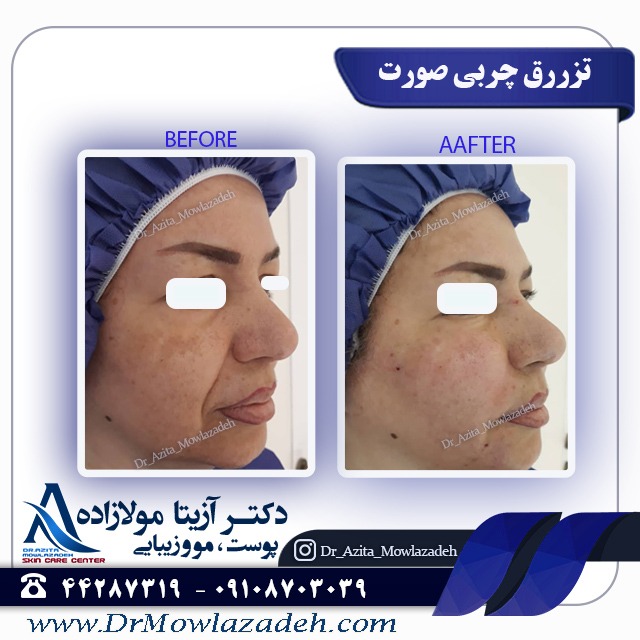 مزایای تزریق چربی