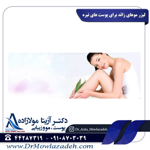 لیزر-موهای-زائد-برای-پوست-های-تیره