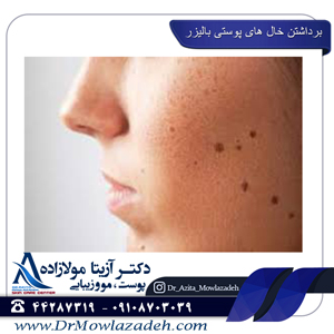 برداشتن-خال-پوستی-با-لیزر