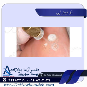 کرایوتراپی