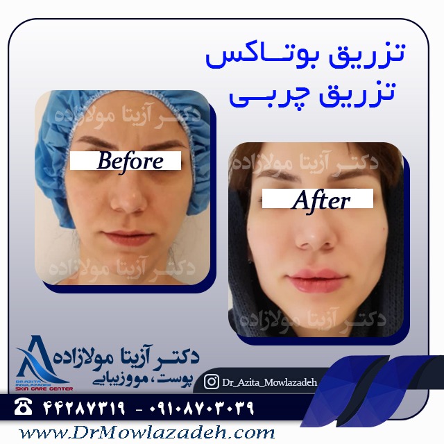 تزریق بوتاکس صورت