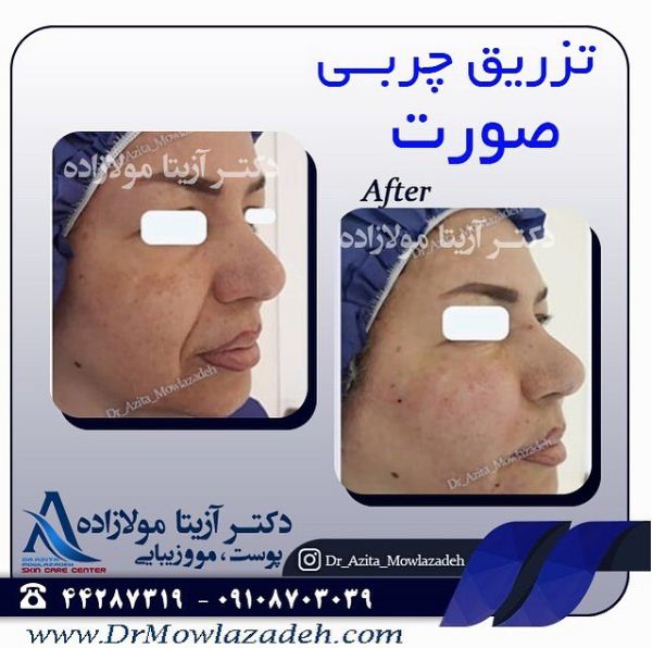 تزریق چربی