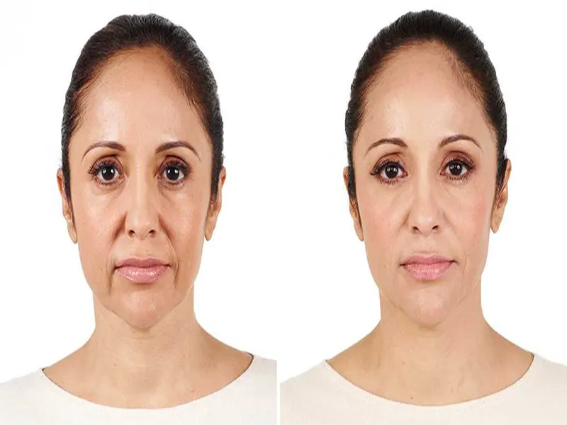 تزریق فیلر برای خط خنده