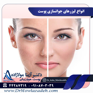 انواع لیزرهای جوانسازی پوست